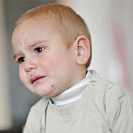 Measles Symptoms In Toddlers